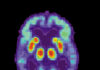 FDA Approves Alzheimer’s Medication Leqembi