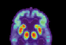 FDA Approves Alzheimer’s Medication Leqembi