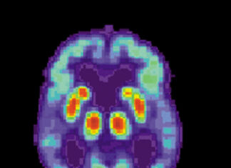 FDA Approves Alzheimer’s Medication Leqembi