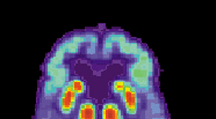 FDA Approves Alzheimer’s Medication Leqembi