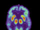 FDA Approves Alzheimer’s Medication Leqembi
